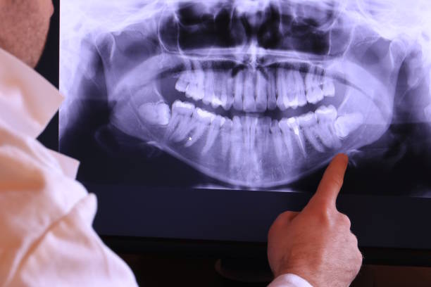 Best Emergency Dentist for Lost Fillings or Crowns in Red Oaks Mill, NY
